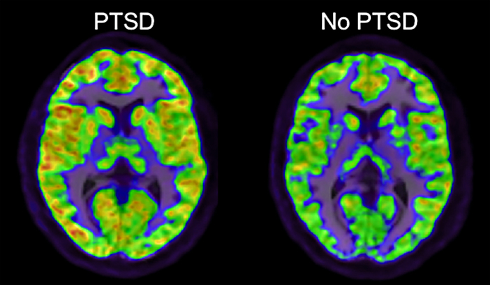 Computerized Tomography (CT) Scan of a brain with and without PTSD